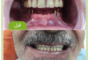 دندان مصنوعی بر پایه ایمپلنت چیست و چه انواعی دارد؟