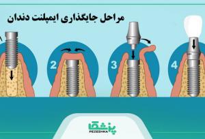 قیمت ایمپلنت دندان در سال 1404 + جدول هزینه انواع برندها【سال1404】