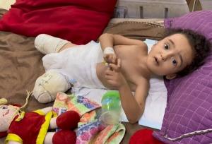 مقام بهداشتی غزه از افزایش ۲۲۵ درصدی قطع عضو در جنگ غزه خبر داد
