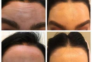 ۸ توصیه برای بوتاکس اولی‌ها که باید بدانید