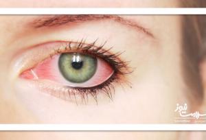از ویروس چشمی چه می دانید؟