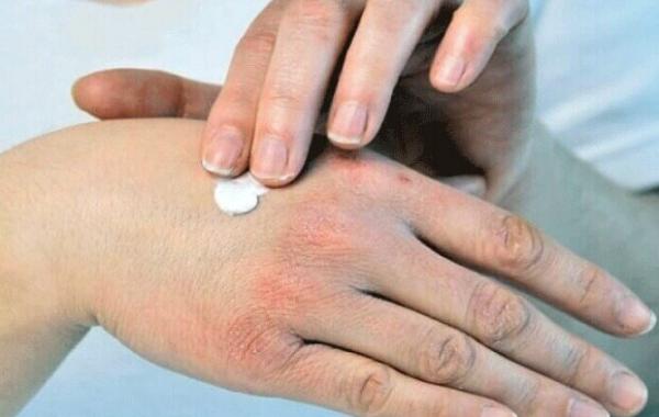 راهکارهای طب ایرانی برای سلامت پوست در فصل سرد