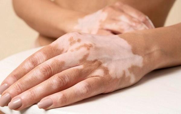 تازه‌ترین توصیه‌های پزشکی برای لک‌های پوستی