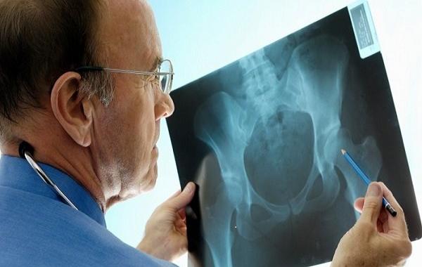 تشخیص و درمان آرتروز لگن با کمک هوش مصنوعی