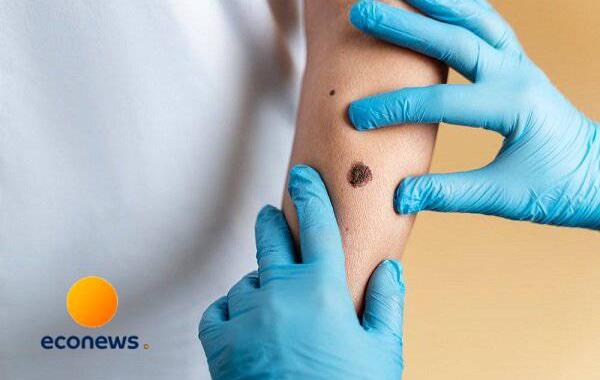  نتایج موفق تست داروی ضد سرطان پوست ایرانی