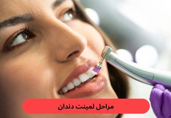 چگونه سایه مناسب لمینت دندان، چهره شما را جوان‌تر نشان می‌دهد؟