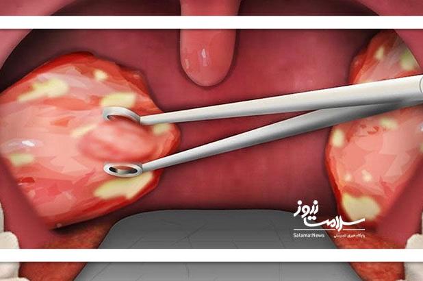 چه زمانی نیاز به جراحی لوزه داریم؟