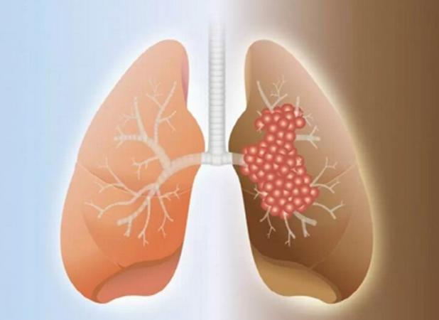 روش تشخیص نوین بیماری فیبروز ریه در بوشهر استفاده می‌شود