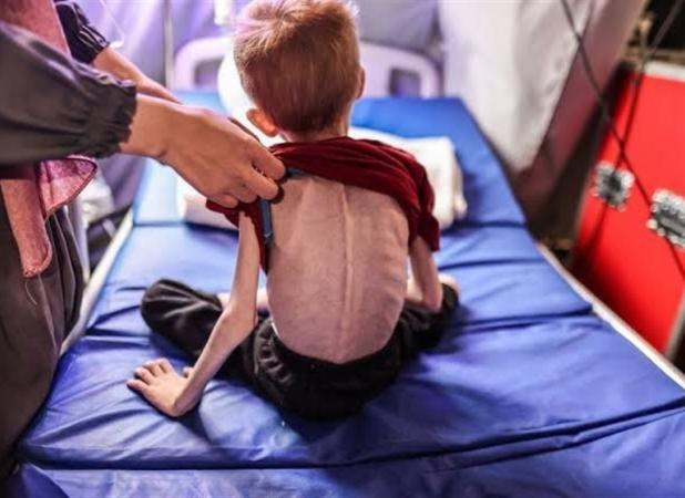 جنگ غزه| از هر ۱۰ کودک، یک کودک در غزه دچار سوءتغذیه است