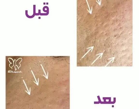 فوتونا فرکشنال یا فوردی؟ جوانسازی بدون جراحی و رفع جای جوش با لیزر فوتونا در مشهد