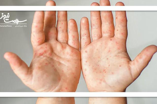 تب برفکی: بیماری‌ ایمن از انتقال به انسان / نظارت‌های دقیق دامپزشکی محصولات آلوده را از بازار خارج می‌کند