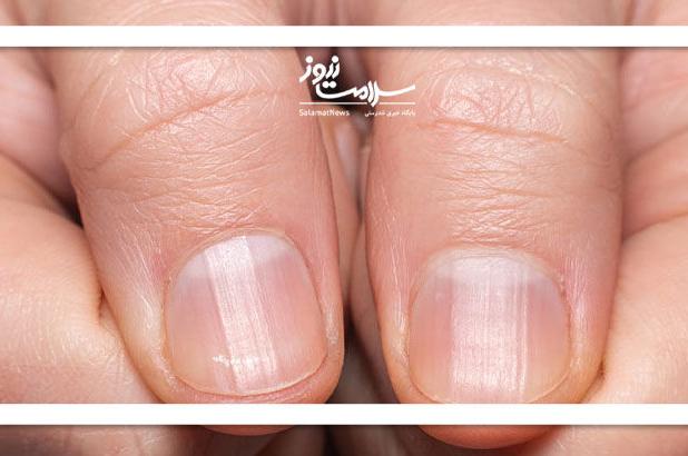 تغییرات هلال ناخن را جدی بگیرید
