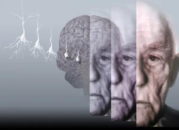 طراحی ابزار هوش مصنوعی برای تشخیص نوع و شدت زوال عقل