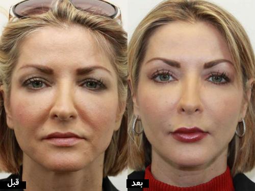 تزریق چربی در کرج با جدیدترین روش‌‌ها + معرفی و بررسی کامل