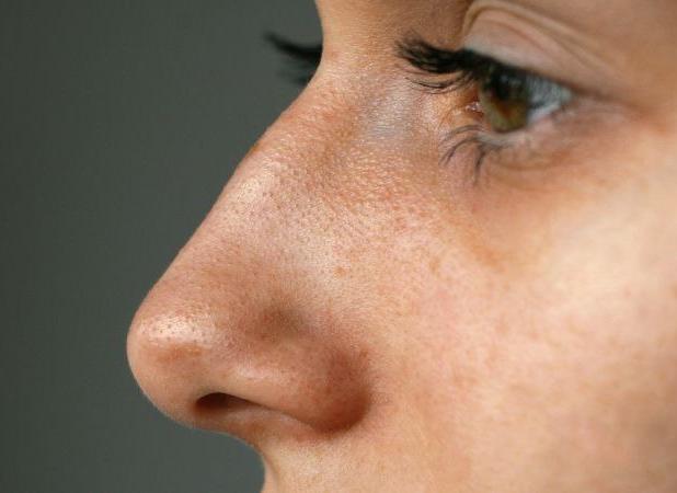 قوز بینی، ترند تازه زیبایی ۲۰۲۶ شد!