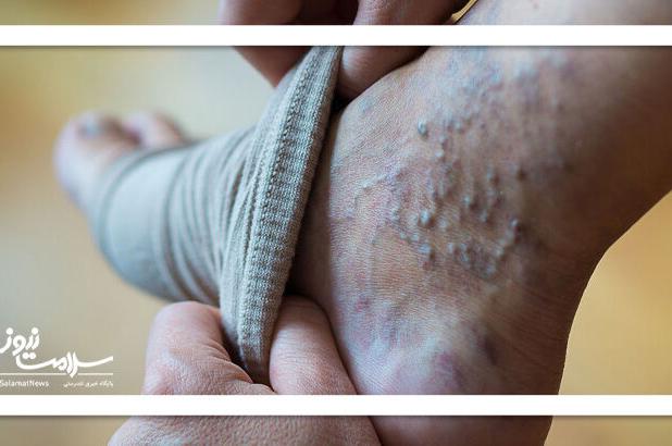 واریس پا: خودمراقبتی و روش‌های خانگی موثر