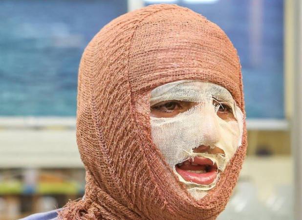 جلالی: سالانه حدود ۳۰۰ هزار نفر به مراکز سوختگی کشور مراجعه می‌کنند