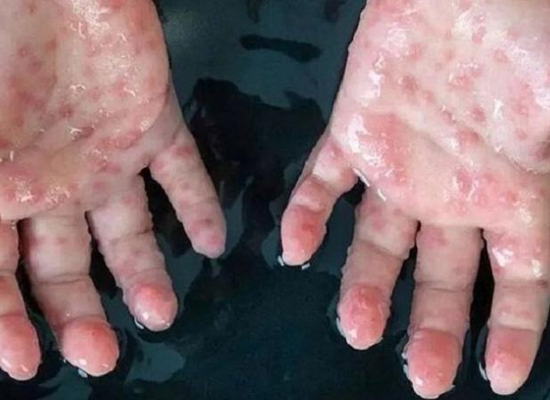 نباید منتظر شیوع آبله میمونی مانند کرونا باشیم