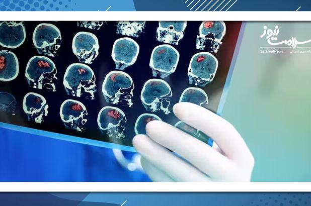 تشخیص ۹ نوع زوال عقل با یک اسکن توسط هوش مصنوعی