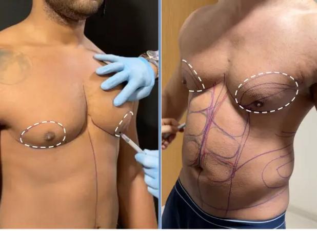 تفاوت ژنیکوماستی و چاقی سینه چیست؟