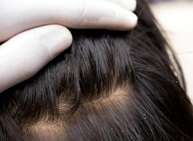 سن شایع آلودگی کودکان با شپش سر ۳ تا ۱۲ سال است