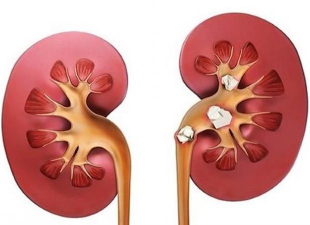 علائم سنگ کلیه؛ چه افرادی بیشتر در معرض ابتلا هستند؟