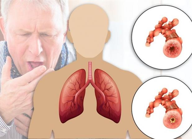 ابتلای 10 میلیون ایرانی به آسم و انسداد ریوی/ غلظت آلاینده‌های هوای تهران 30 برابر حد مجاز