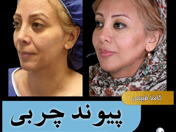 بهترین متخصص تزریق چربی به صورت در تهران کیست؟