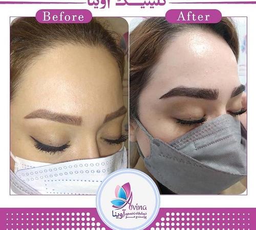 کاشت ابرو در شمال تهران