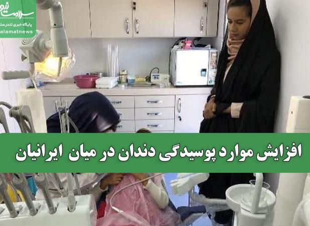 افزایش موارد پوسیدگی دندان در میان  ایرانیان