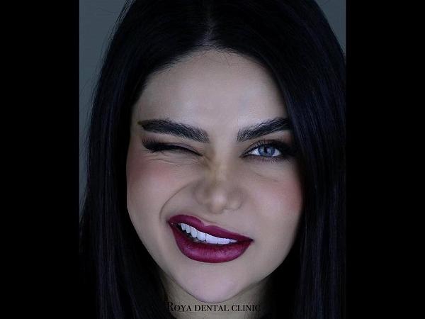 قیمت کامپوزیت دندان در سال ۱۴۰۴ (پرداخت اقساطی هزینه)