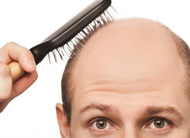 "ریزش مو" از عوارض کرونا/ ریزش چند تار مو در طول روز طبیعی است؟!