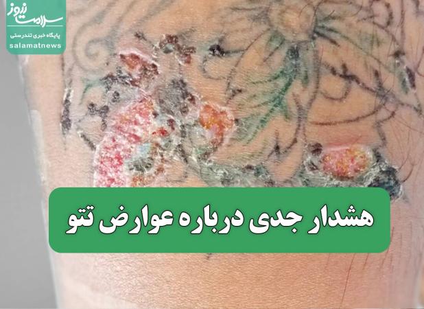 هشدار جدی درباره عوارض تتو: از بیماری های پوستی گرفته تا حساسیت ها و حتی سرطان