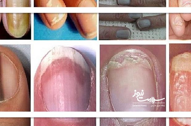 چرا تغییر شکل ناخن را باید جدی گرفت