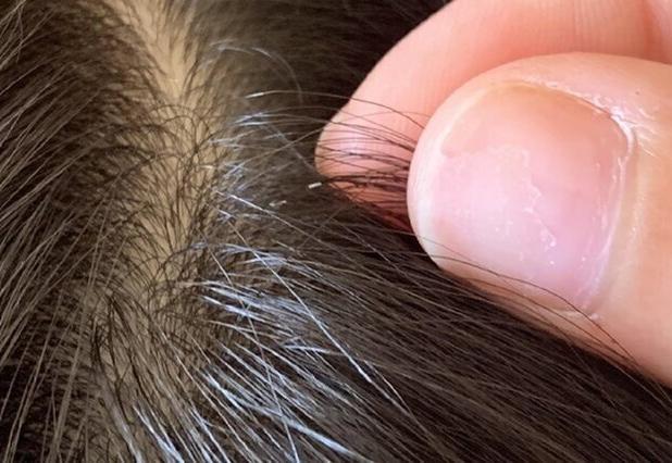 هشدار درباره شیوع شپش سر/ آلودگی به معنای رعایت نکردن بهداشت نیست