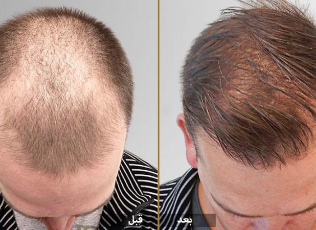 درمان ریزش مو با سلول های بنیادی چگونه انجام می‌شود؟