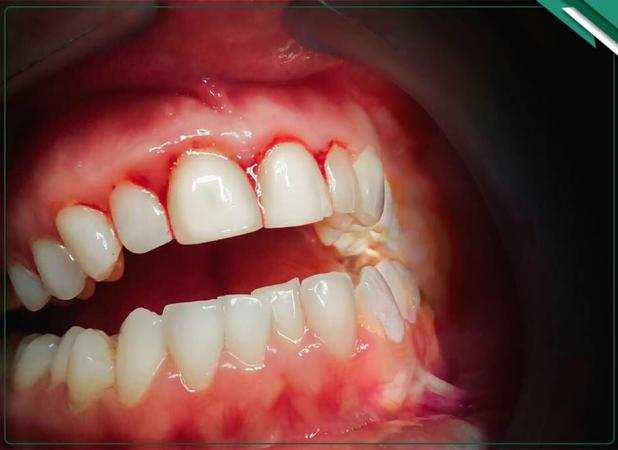 تحلیل لثه در ارتودنسی؛ راهنمای جامع دلایل و راهکارها