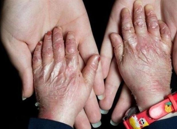 سهمیه تابستان پانسمان‌های تخصصی به خانه EB تحویل شد