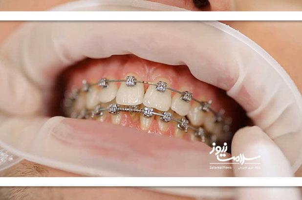 چرا رعایت  بهداشت در ارتودنسی دندان اهمیت بیشتری دارد؟
