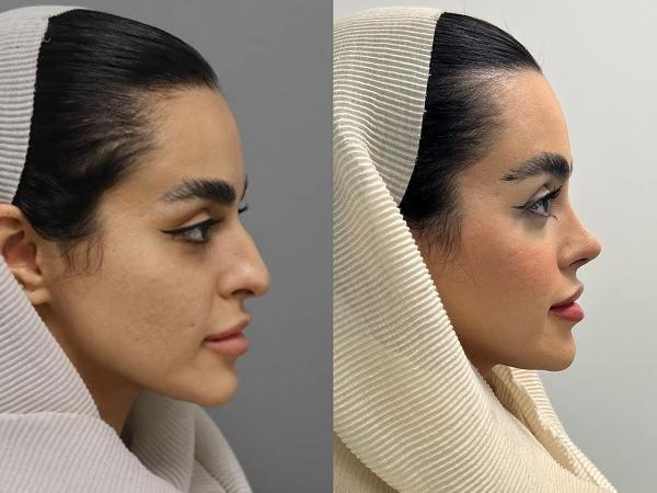 بهترین جراح بینی طبیعی در تهران +معرفی ۱۰ جراحی برتر و نمونه کار