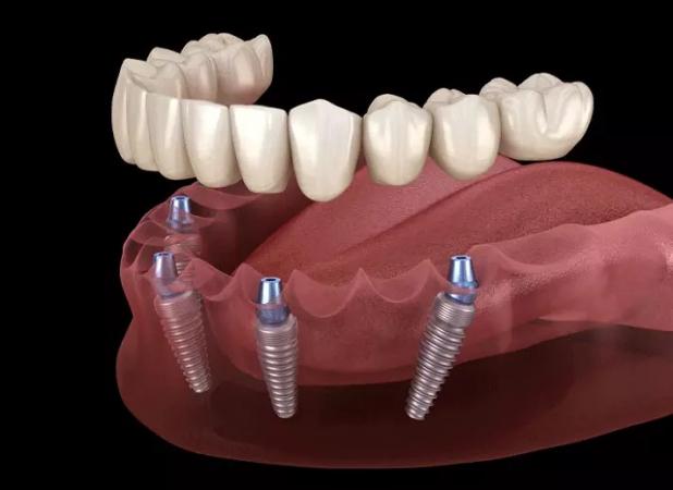 بررسی کامل ایمپلنت تخصصی دندان + انواع، مزایا و قیمت