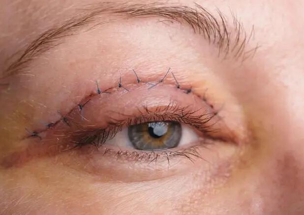 بلفاروپلاستی؛ جراحی برای جوان‌تر شدن چشم‌ها، نه تغییر فرم آن‌ها"