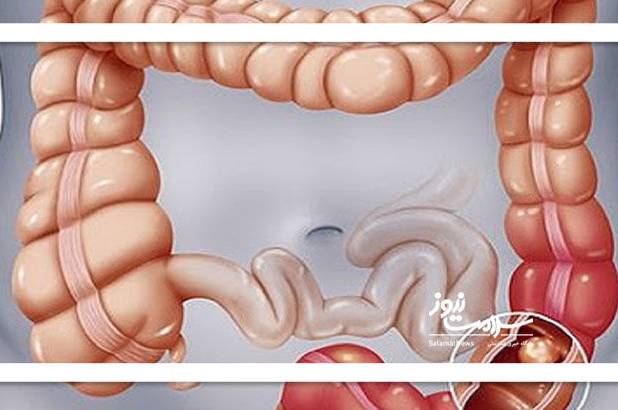 نکاتی که در پیشگیری از سرطان روده نقش دارد