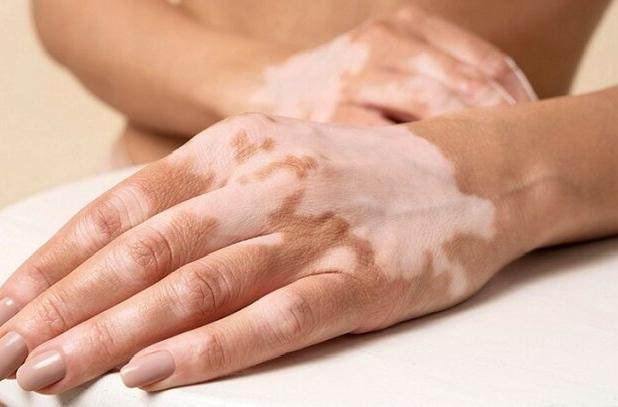 تازه‌ترین توصیه‌های پزشکی برای کنترل لک‌های پوستی