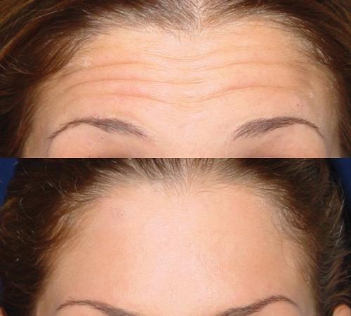 بهترین برندهای بوتاکس برای پیشانی کدامند؟