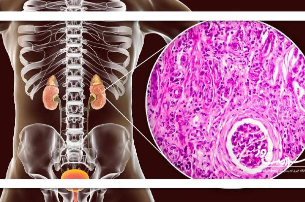 گلومرولواسکلروز فوکال سگمنتال (FSGS) چیست؟