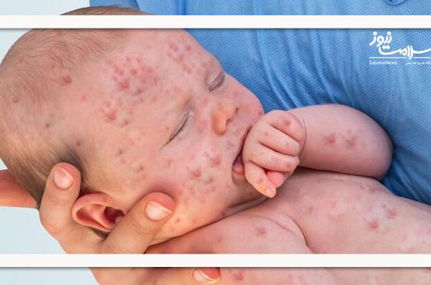 افزایش ابتلا به سرخک در کشور؛ ۱۴۱ مورد شناسایی شد