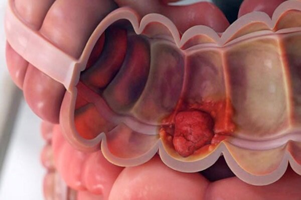 غربالگری و سبک زندگی سالم دو عامل پیشگیری از سرطان روده