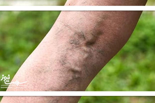 چگونه از واریس پیشگیری کنیم؟ با چند تغییر ساده!