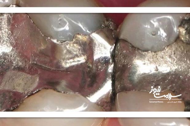 آیا آمالگام سمی است؟